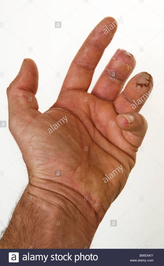 Layou man loses finger twice