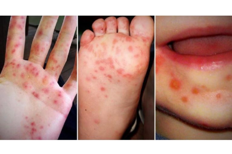 cases-of-hand-foot-and-mouth-disease-confirmed-in-svg-schools